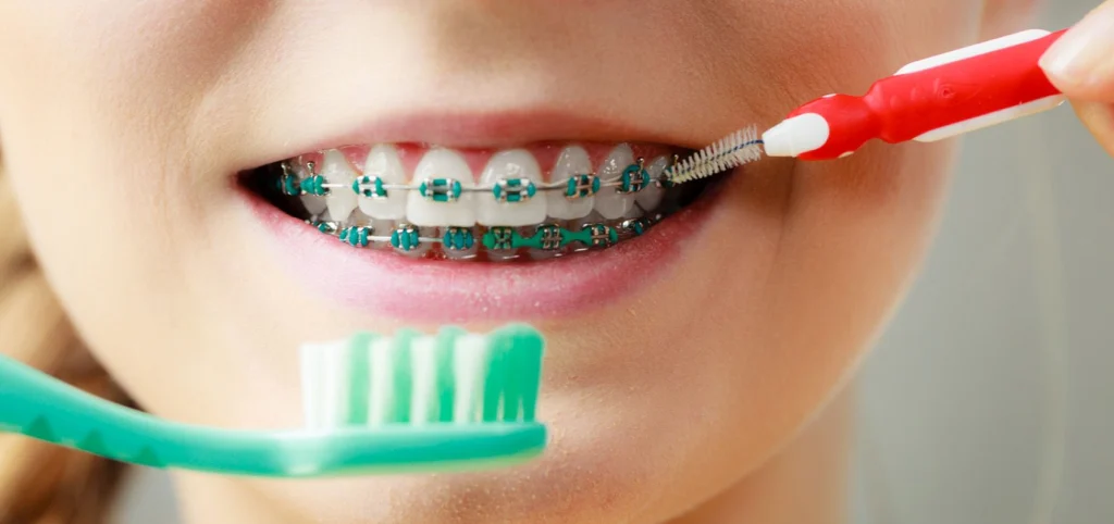 Orthodontie de l'adolescent à Vitrolles