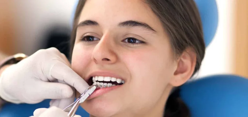 Multi-bagues partiel à Vitrolles - Orthodontiste Saint-Victoret